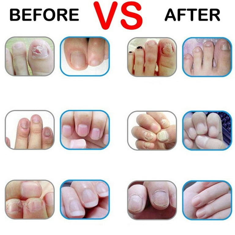 Nail fungal treatment pen