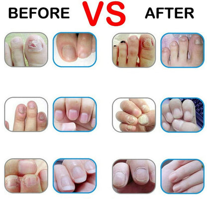 Nail fungal treatment pen